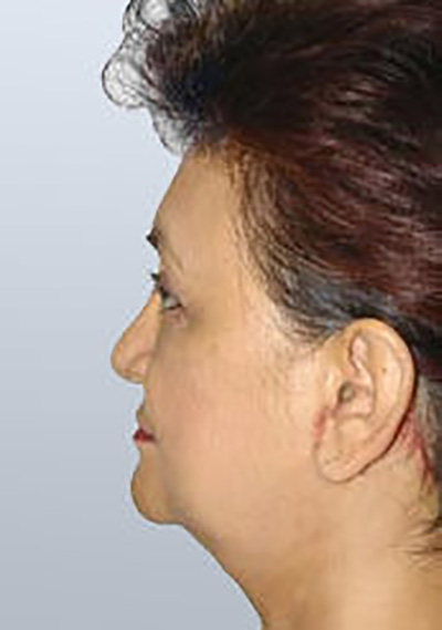 facelift-cosmetic-surgery-claremont-upland-woman-after-side-dr-maan-kattash