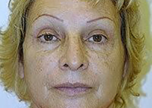 facelift-plastic-surgery-los-angeles-woman-after-front-dr-maan-kattash