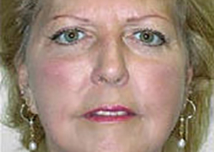 facelift-plastic-surgery-rancho-cucamonga-woman-after-front-dr-maan-kattash