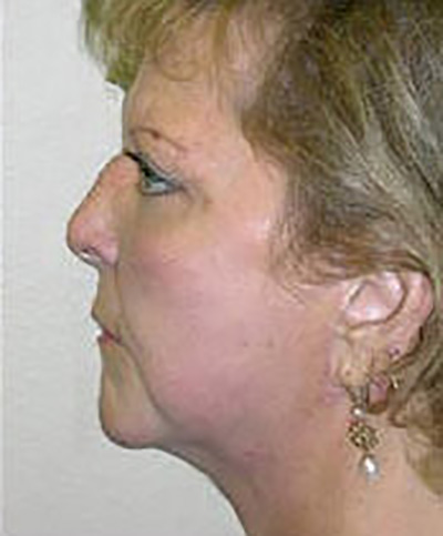 facelift-plastic-surgery-rancho-cucamonga-woman-after-side-dr-maan-kattash