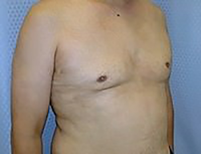 gynecomastia-male-breast-reduction-surgery-los-angeles-after-oblique-dr-maan-kattash-2