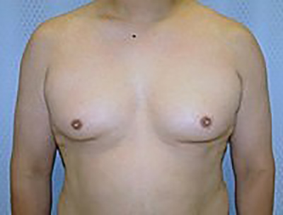 gynecomastia-male-breast-reduction-surgery-los-angeles-before-front-dr-maan-kattash-2