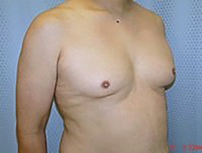 gynecomastia-male-breast-reduction-surgery-los-angeles-before-oblique-dr-maan-kattash-2