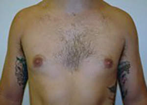 gynecomastia-male-breast-reduction-surgery-ontario-after-front-dr-maan-kattash