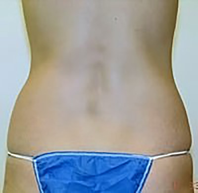 liposuction-plastic-surgery-beverly-hills-woman-before-back-dr-maan-kattash