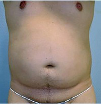 liposuction-plastic-surgery-upland-man-before-front-dr-maan-kattash