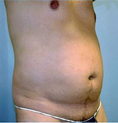 liposuction-plastic-surgery-upland-man-before-oblique-dr-maan-kattash
