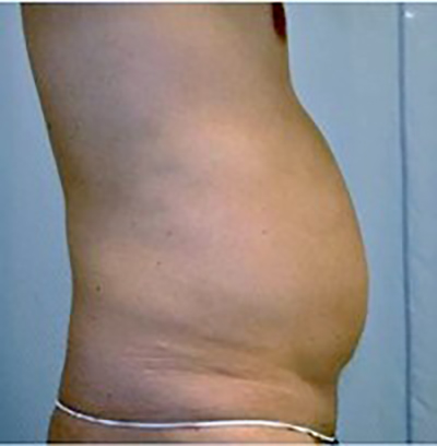 liposuction-plastic-surgery-upland-man-before-side-dr-maan-kattash