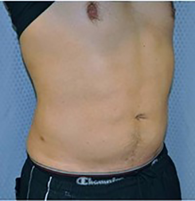 liposuction-plastic-surgery-upland-man-woman-after-oblique-dr-maan-kattash