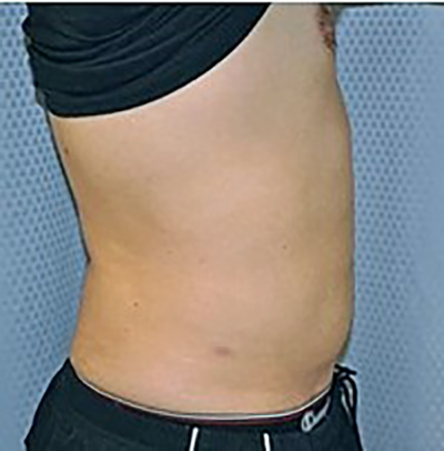 liposuction-plastic-surgery-upland-man-woman-after-side-dr-maan-kattash