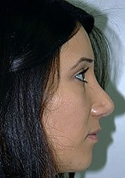 rhinoplasty-plastic-surgery-nose-job-inland-empire-woman-after-side-dr-maan-kattash2