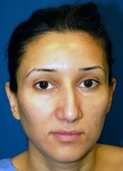 rhinoplasty-plastic-surgery-nose-job-inland-empire-woman-before-front-dr-maan-kattash2