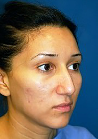 rhinoplasty-plastic-surgery-nose-job-inland-empire-woman-before-oblique-dr-maan-kattash2