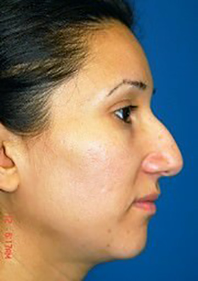 rhinoplasty-plastic-surgery-nose-job-inland-empire-woman-before-side-dr-maan-kattash2