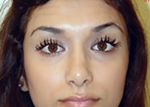 rhinoplasty-plastic-surgery-nose-job-irvine-woman-after-front-dr-maan-kattash2