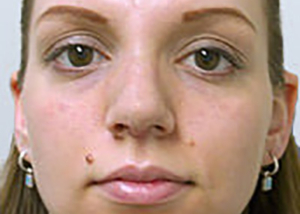 rhinoplasty-surgery-nose-job-los-angeles-woman-after-front-dr-maan-kattash2