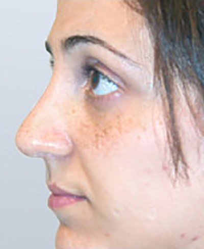 rhinoplasty-surgery-nose-job-tustin-woman-after-side-dr-maan-kattash2