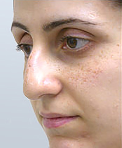 rhinoplasty-surgery-nose-job-tustin-woman-before-oblique-dr-maan-kattash2