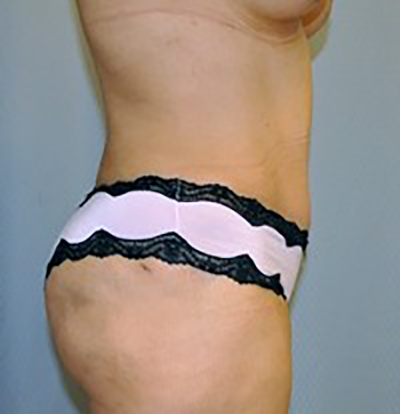 tummy-tuck-cosmetic-surgery-abdominoplasty-beverly-hills-woman-after-side-dr-maan-kattash