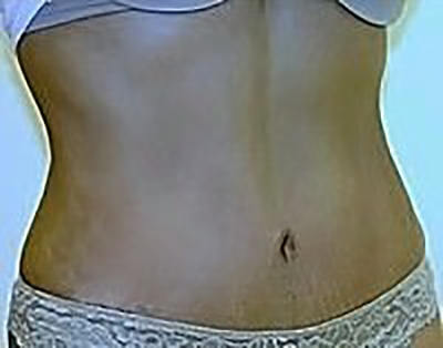 tummy-tuck-cosmetic-surgery-abdominoplasty-claremont-woman-after-oblique-dr-maan-kattash