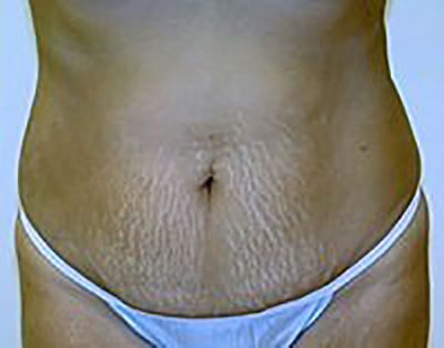 tummy-tuck-cosmetic-surgery-abdominoplasty-claremont-woman-before-front-dr-maan-kattash