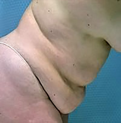 tummy-tuck-plastic-surgery-abdominoplasty-loose-skin-beverly-hills-woman-before-side-dr-maan-kattash